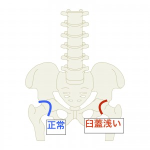 変形性股関節症　臼蓋